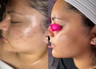 acne Hyperpigmentation results