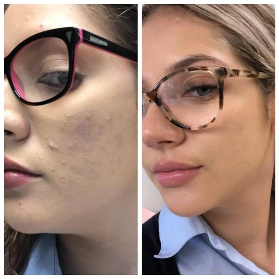 face reality acne treatment results