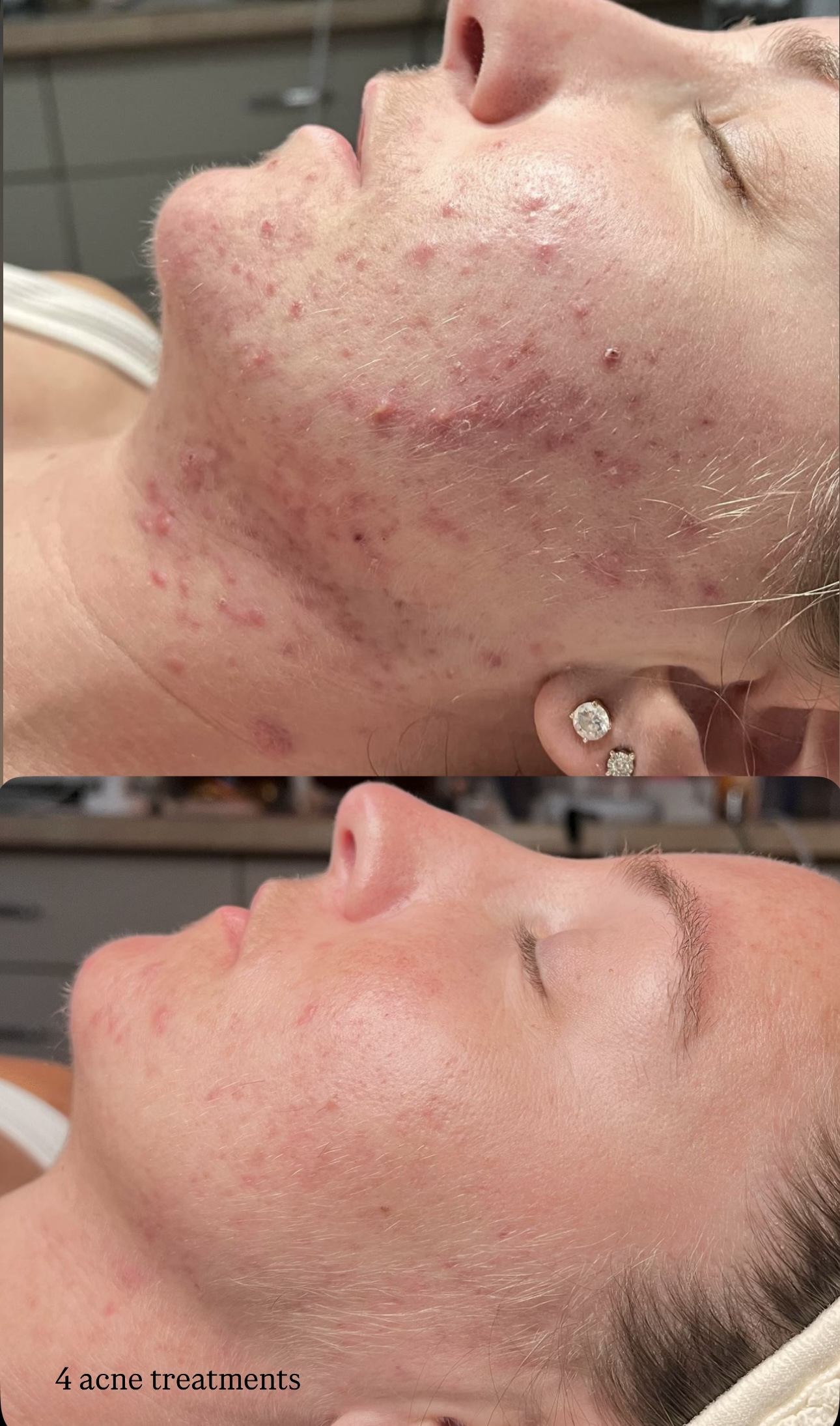 acne after 4 treatments