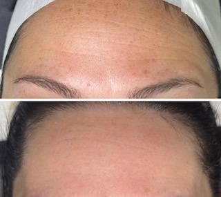 BioRePeel treatment results