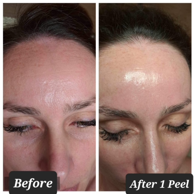 BioRePeel treatment results