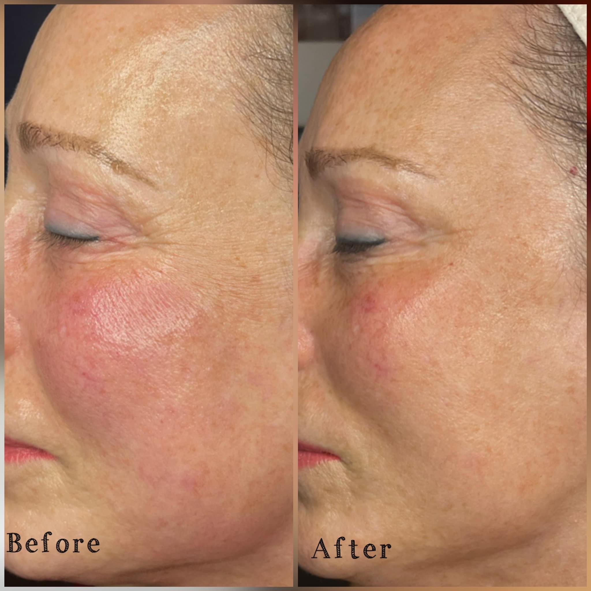 BioRePeel treatment results