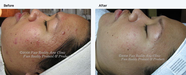 inflamed_acne