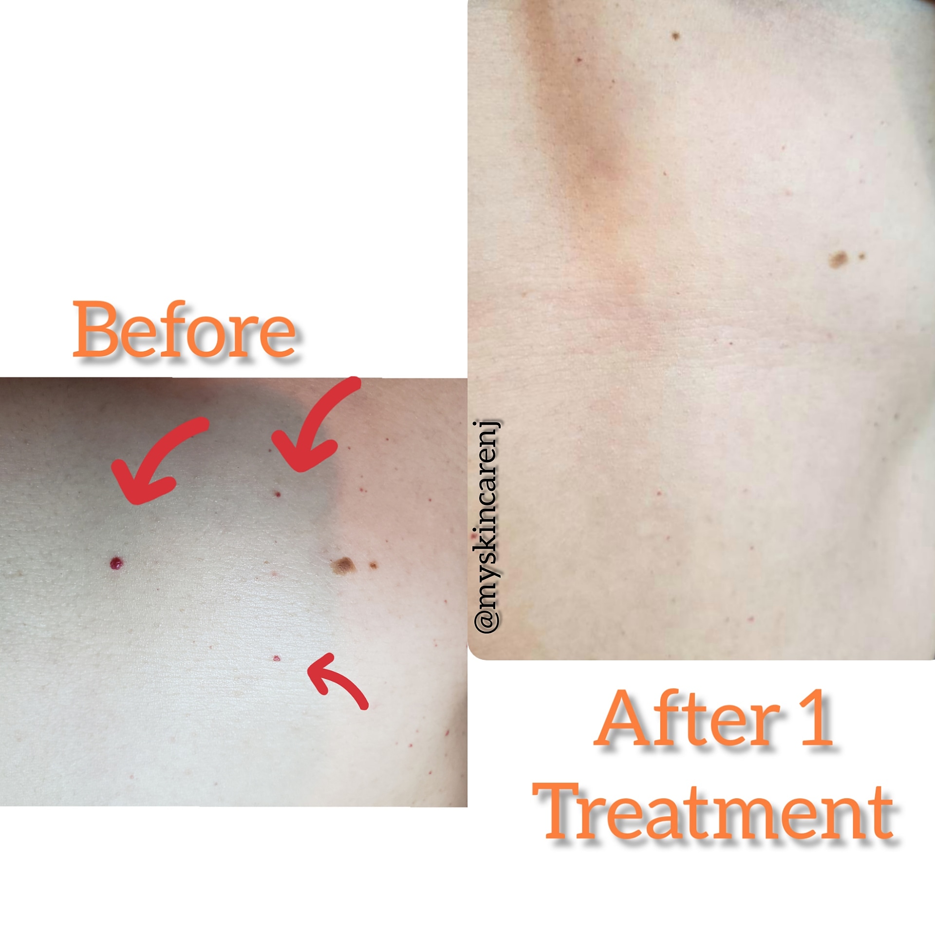 cherry angiomas before & after