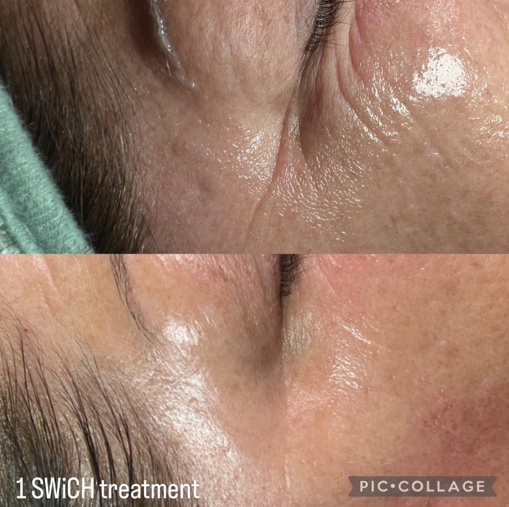 Swich Peel treatment results