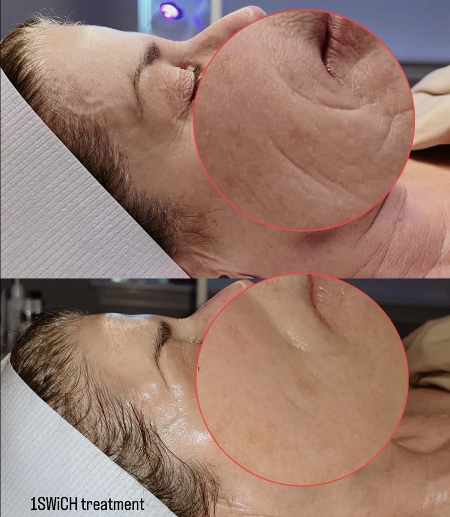 Swich Peel treatment results