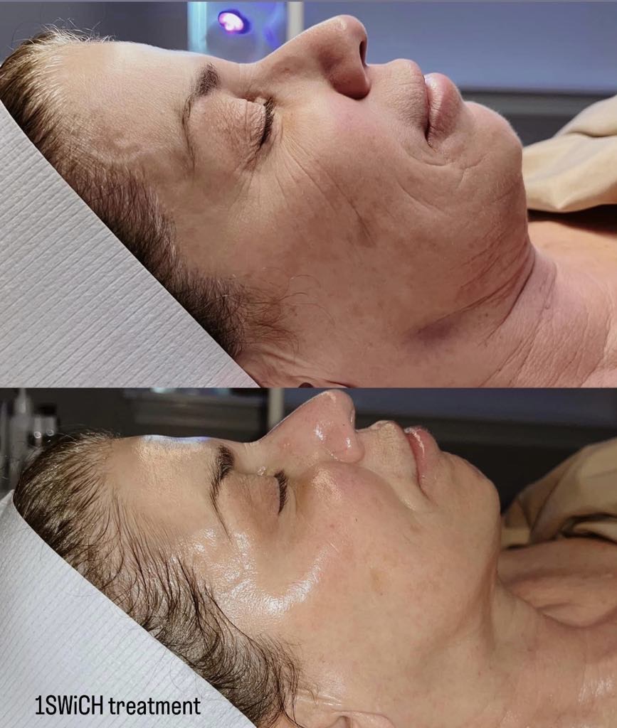 Swich Peel treatment results