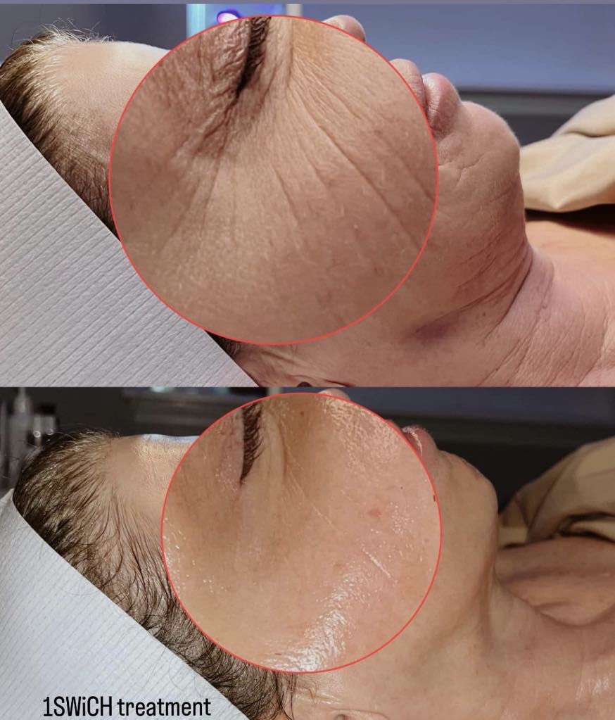 Swich Peel treatment results