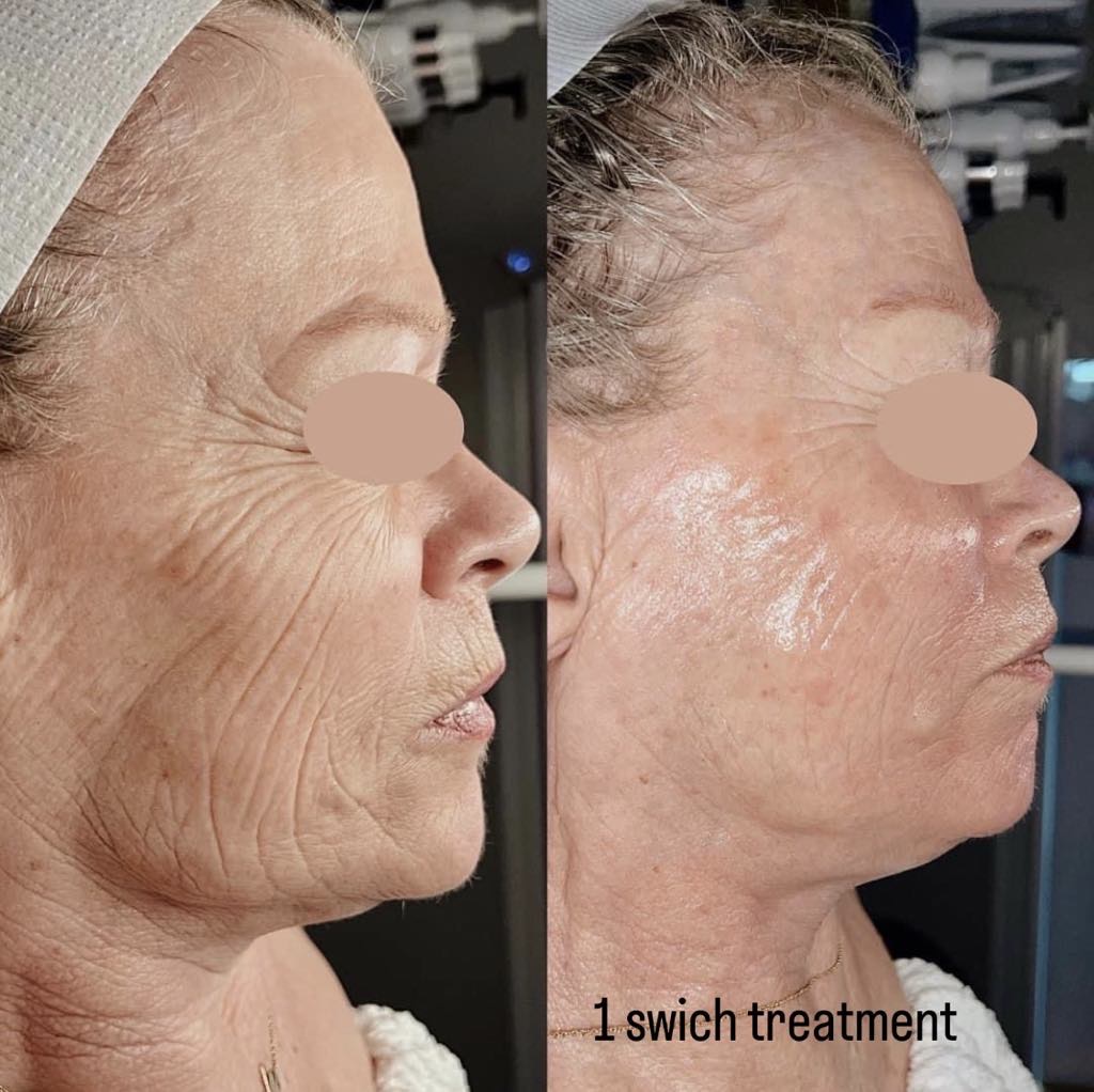Swich Peel treatment results